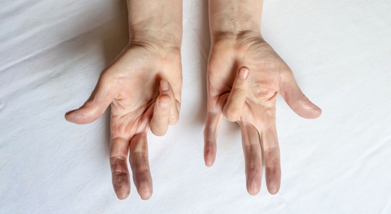 Hands of a patient with Dupuytren's disease
