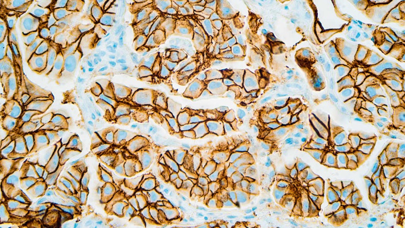 Immunohistochemistry image for HER2 shows positive cell membrane staining in this infiltrating ductal carcinoma. 
